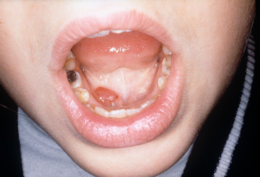 Ranula in a mouth