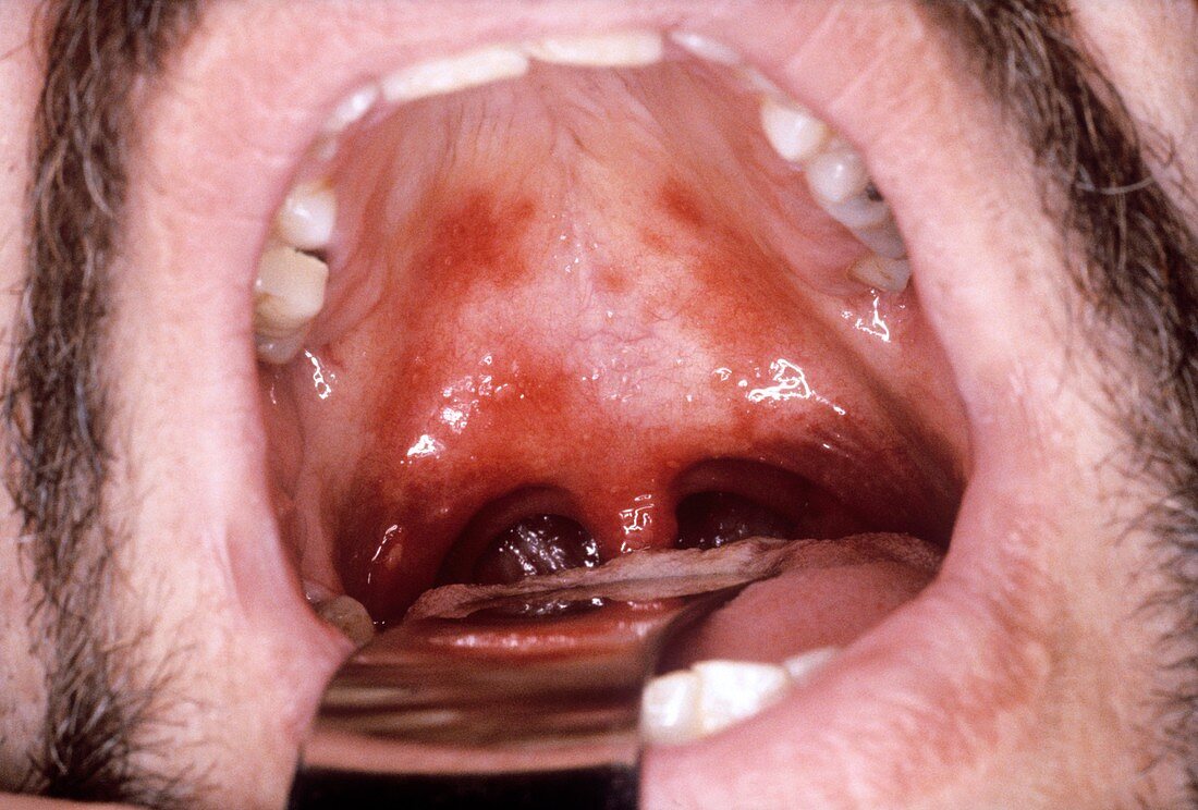 Inflamed mouth
