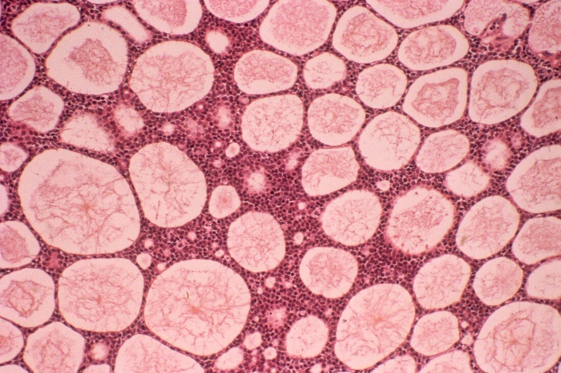 Salivary gland cancer,light micrograph