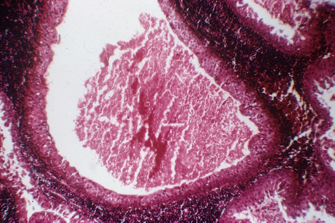 Salivary gland tumour,light micrograph