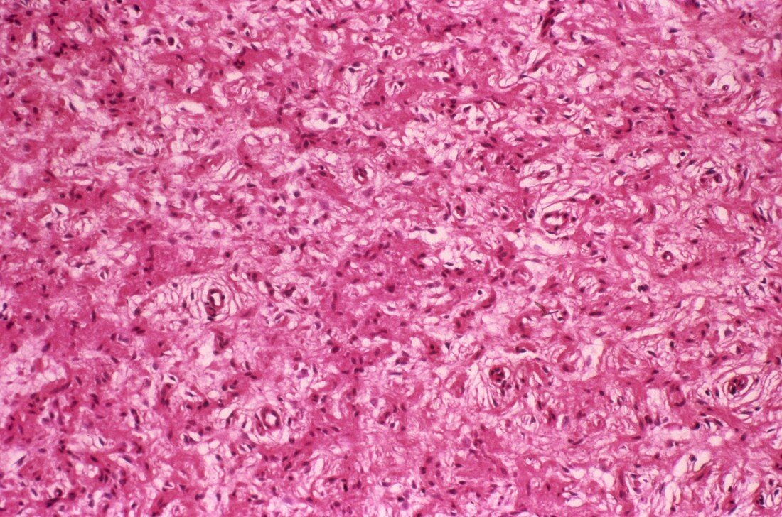 Nervous system tumour,light micrograph
