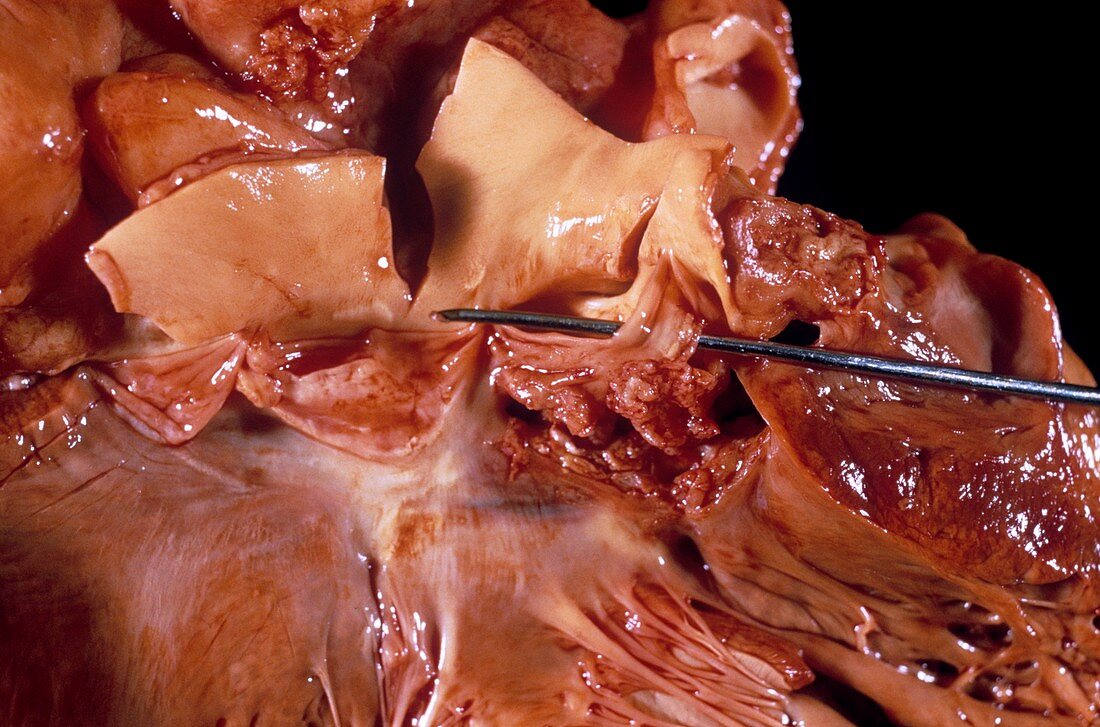 Infective endocarditis