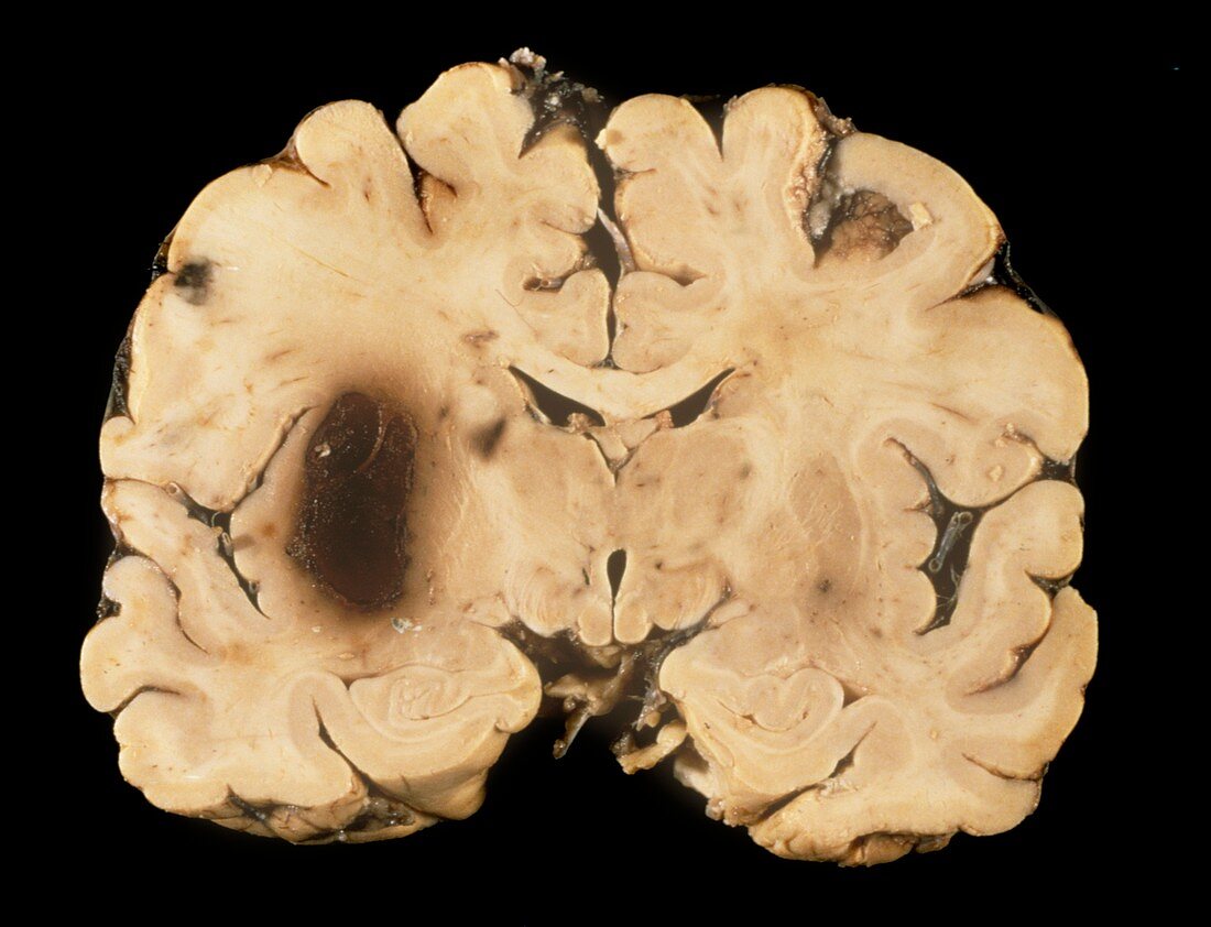 Brain haemorrhage in stroke