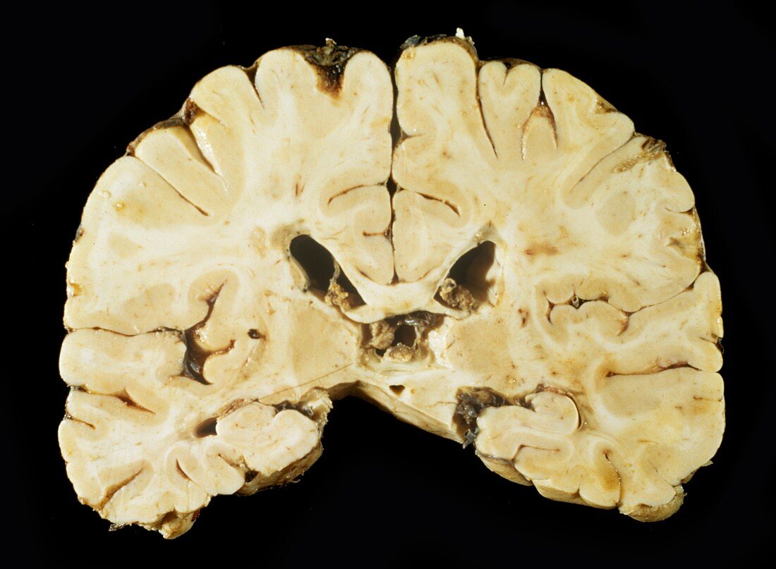 Brain in multiple sclerosis