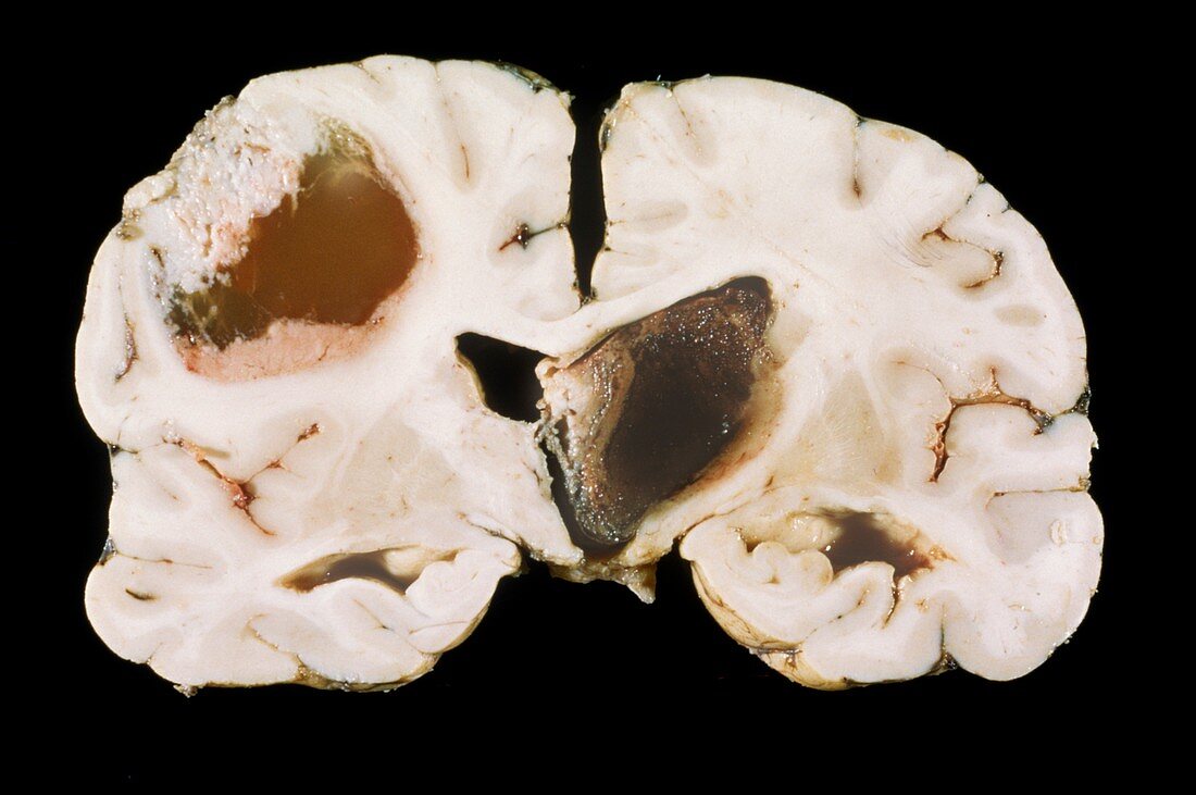 Secondary brain cancer