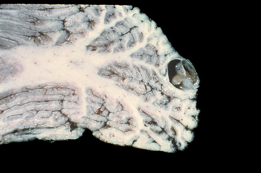 Neurocysticercosis of the brain