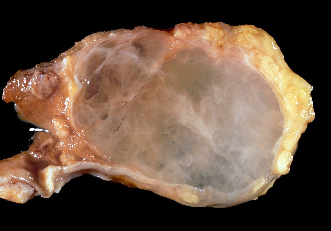 Heart tumour,light micrograph