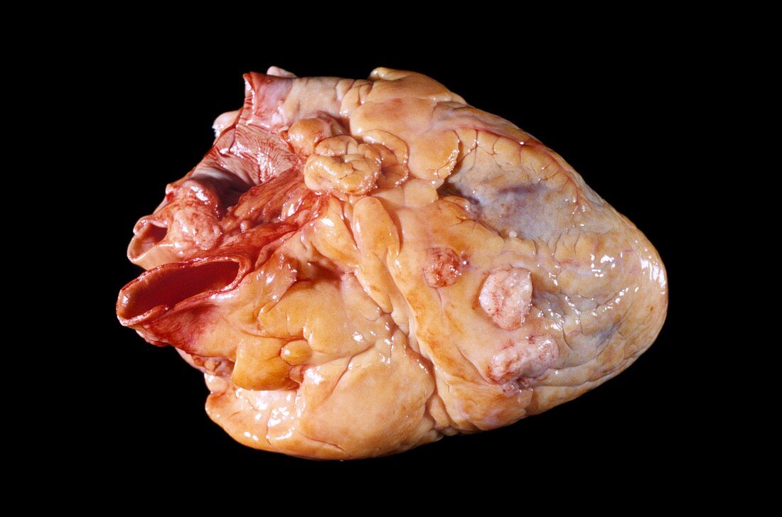 Secondary heart cancer