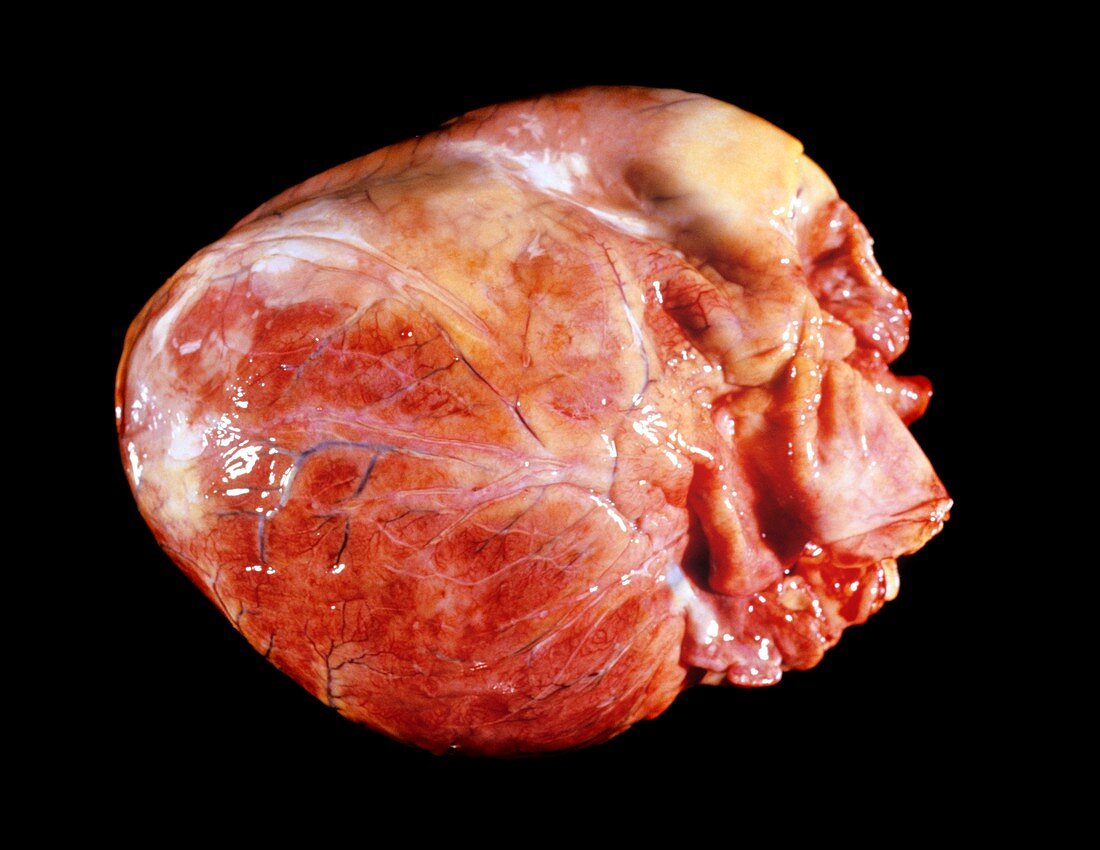 Enlarged heart in acromegaly