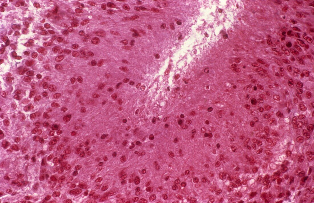 Brain cancer,light micrograph
