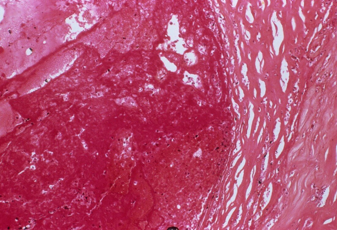 Atherosclerosis,light micrograph