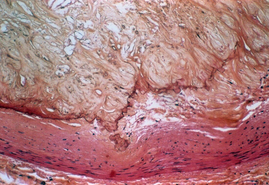 Atherosclerosis,light micrograph