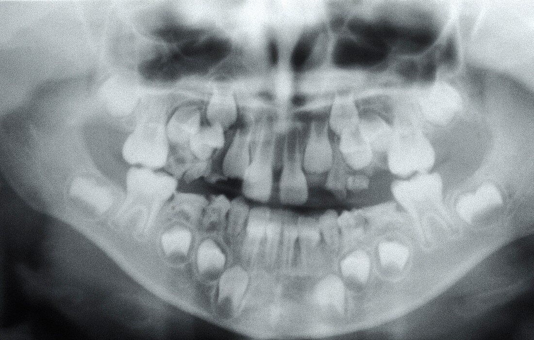 Dental X-ray,7-year-old child