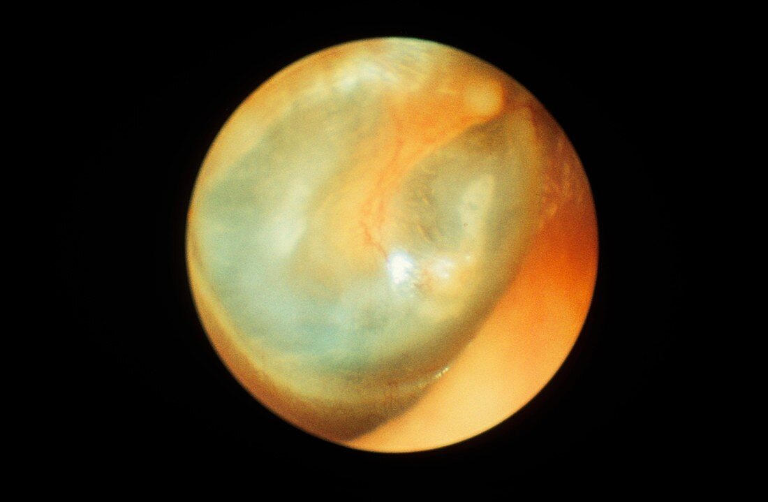 Eardrum,otoscope view