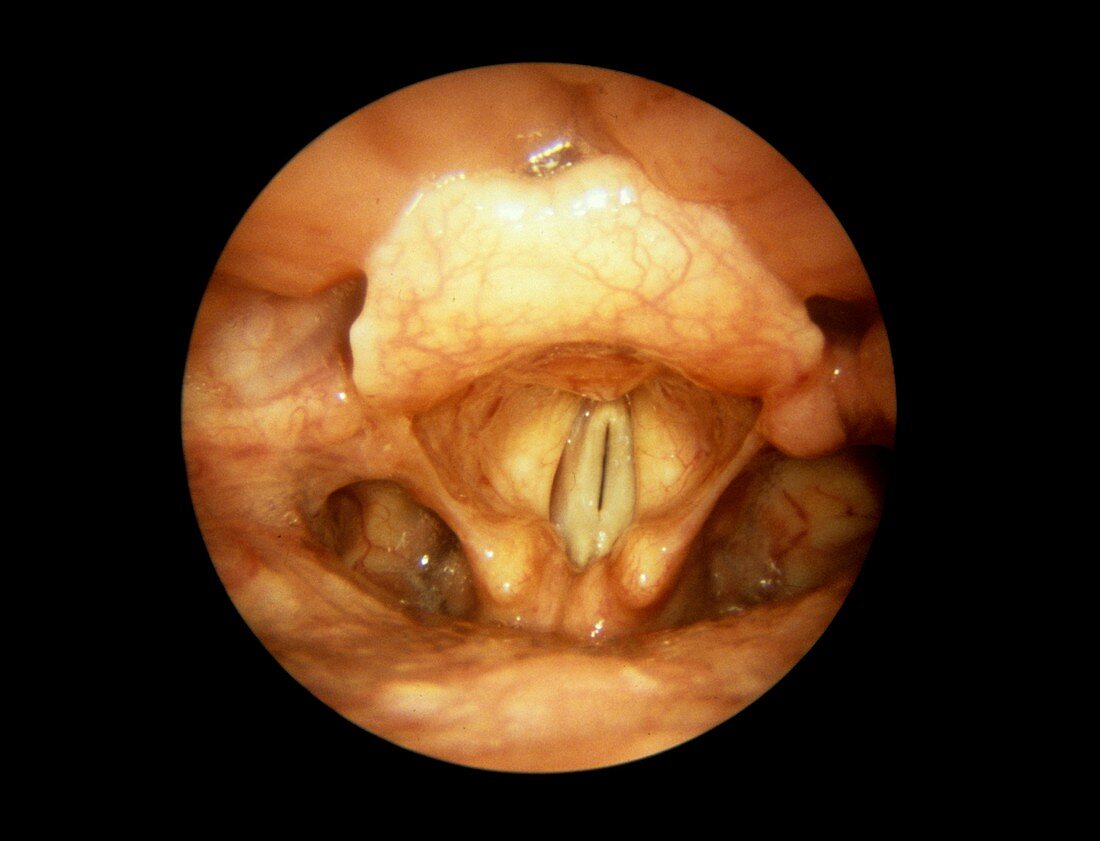 Vocal cords during speech