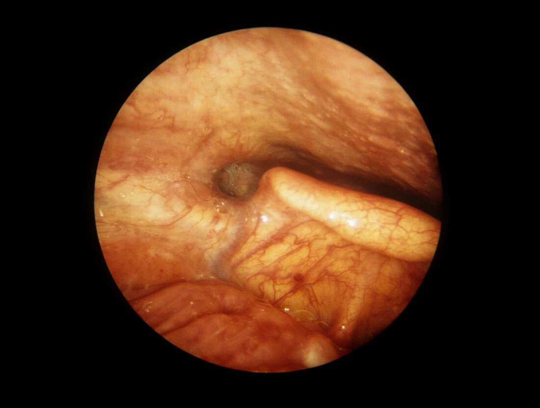 Epiglottis during swallowing