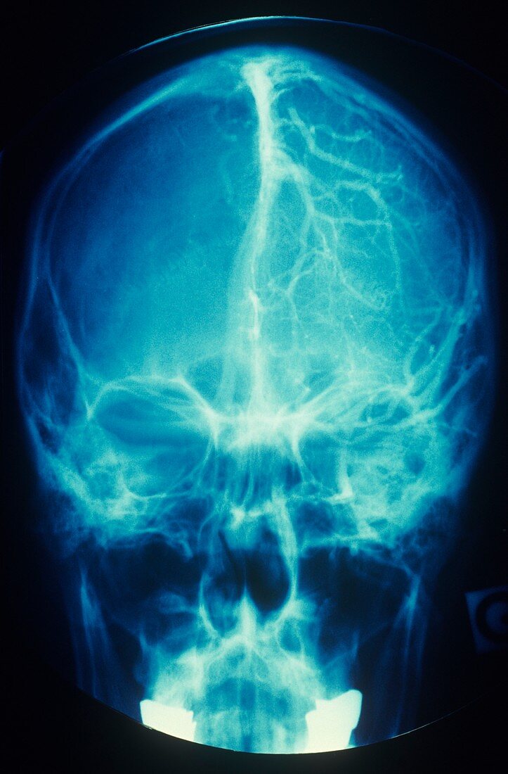 Brain's blood supply,X-ray