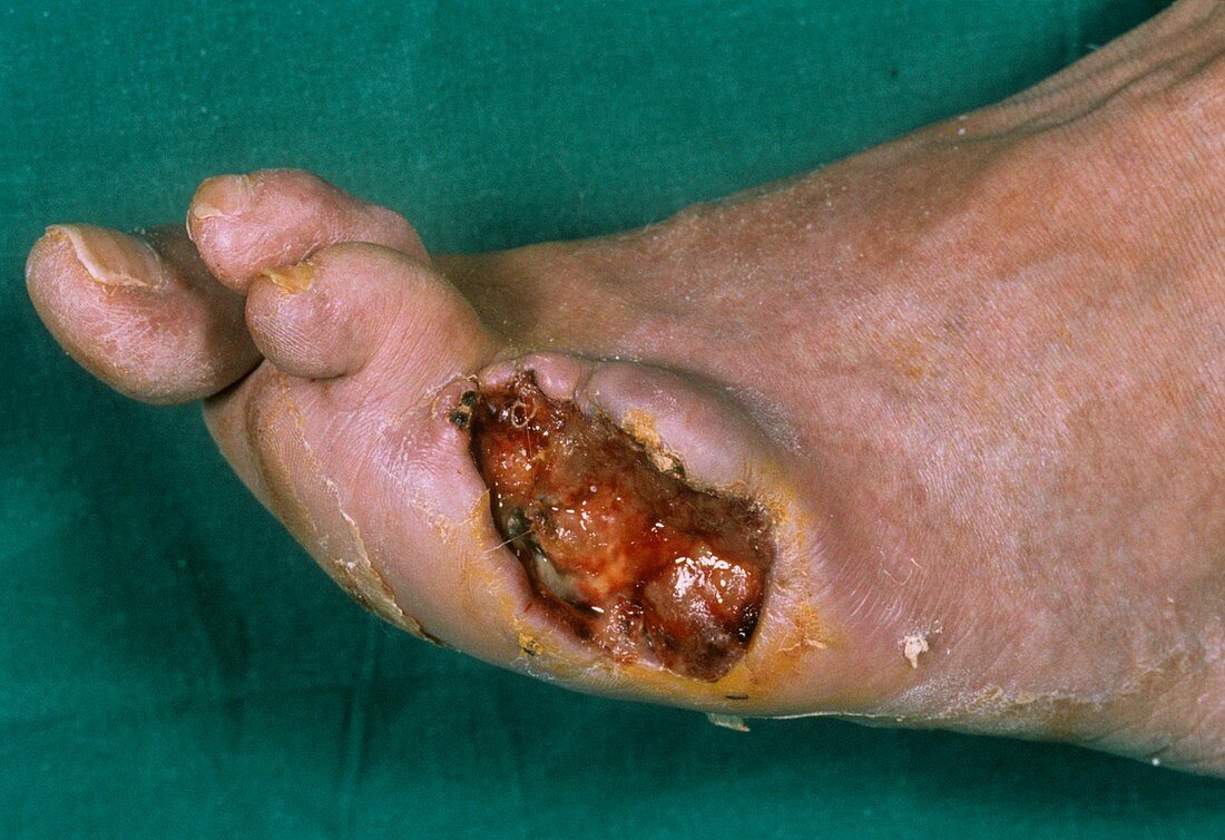 Gangrenous toe in diabetes