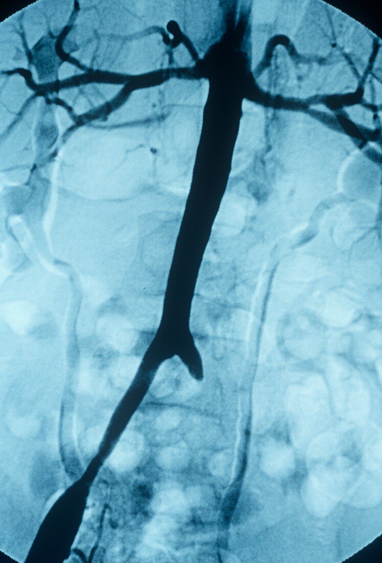 Occluded artery,X-ray