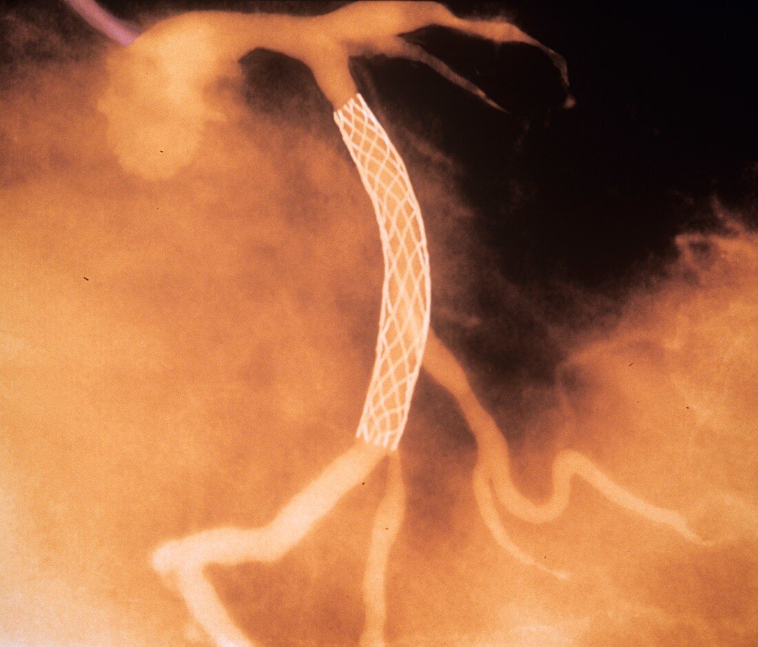 Coronary stent,X-ray