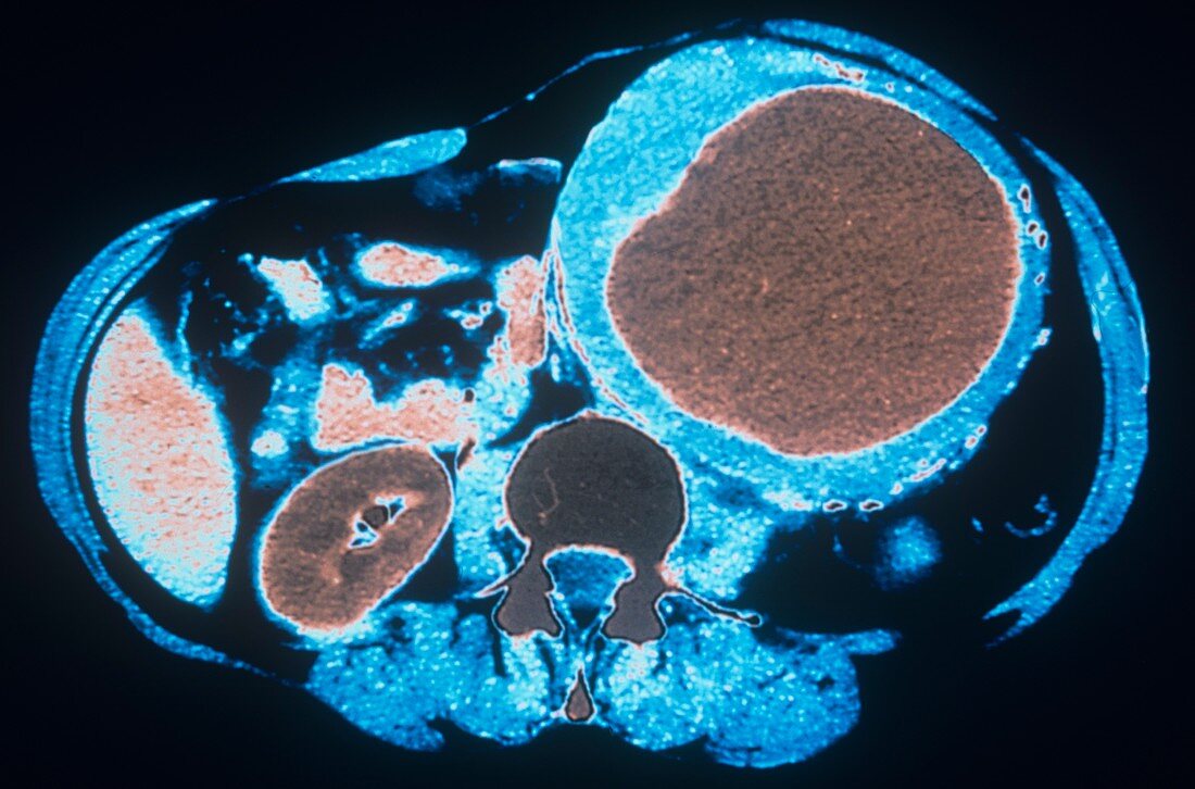 Aortic aneurysm,CT scan