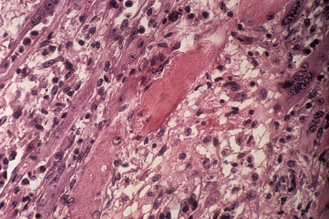Damaged muscle tissue,light micrograph