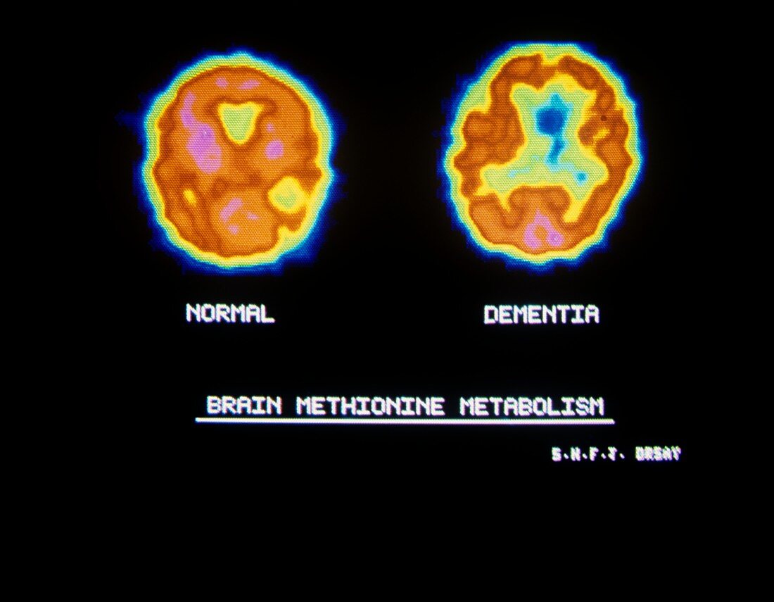 Brain in Alzheimer's disease,PET scan