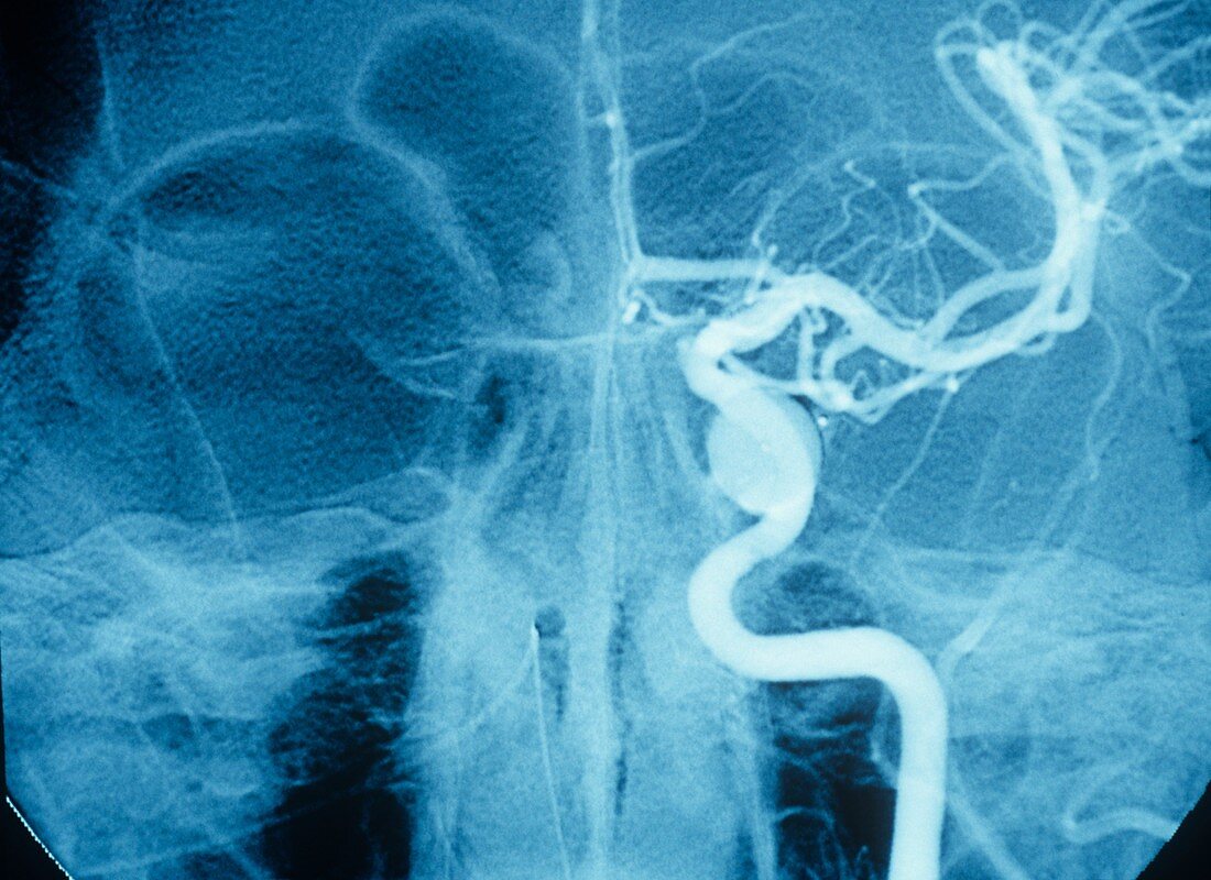 Treated carotid-cavernous fistula,X-ray