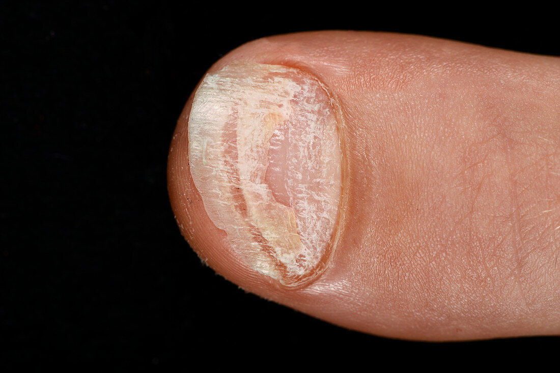 Fingernail psoriasis