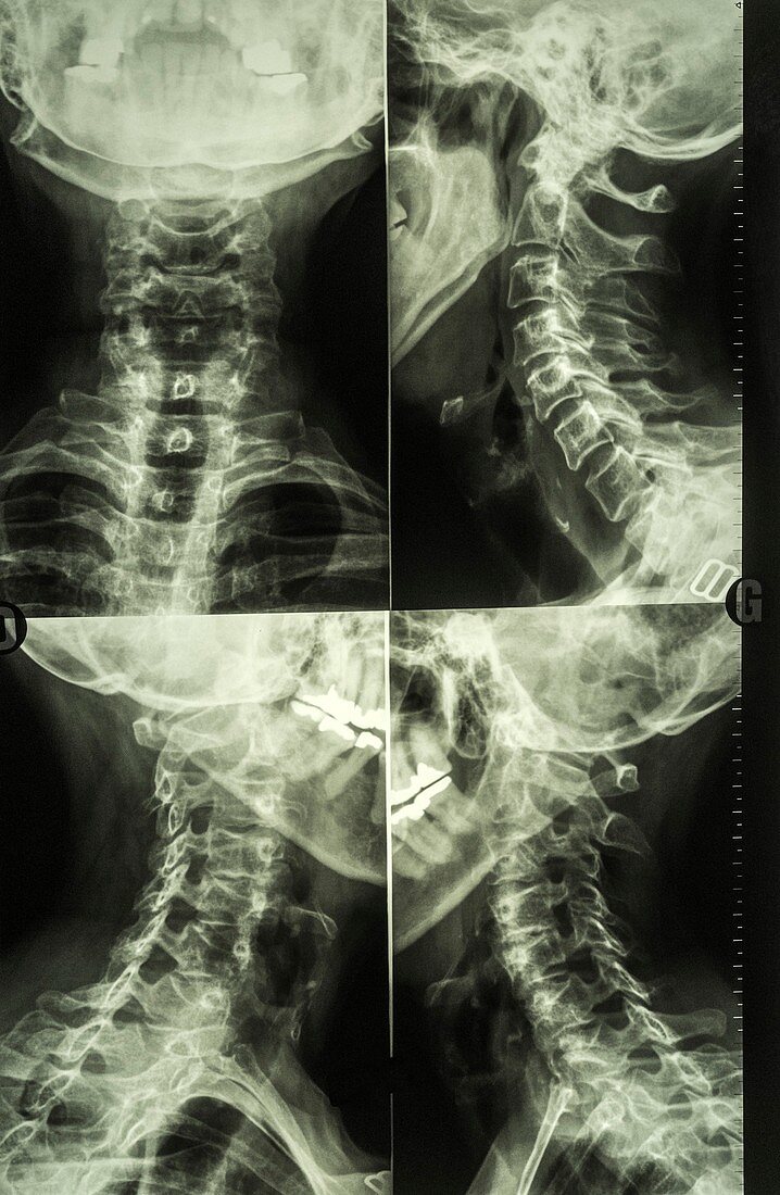 Diagnostic neck X-rays