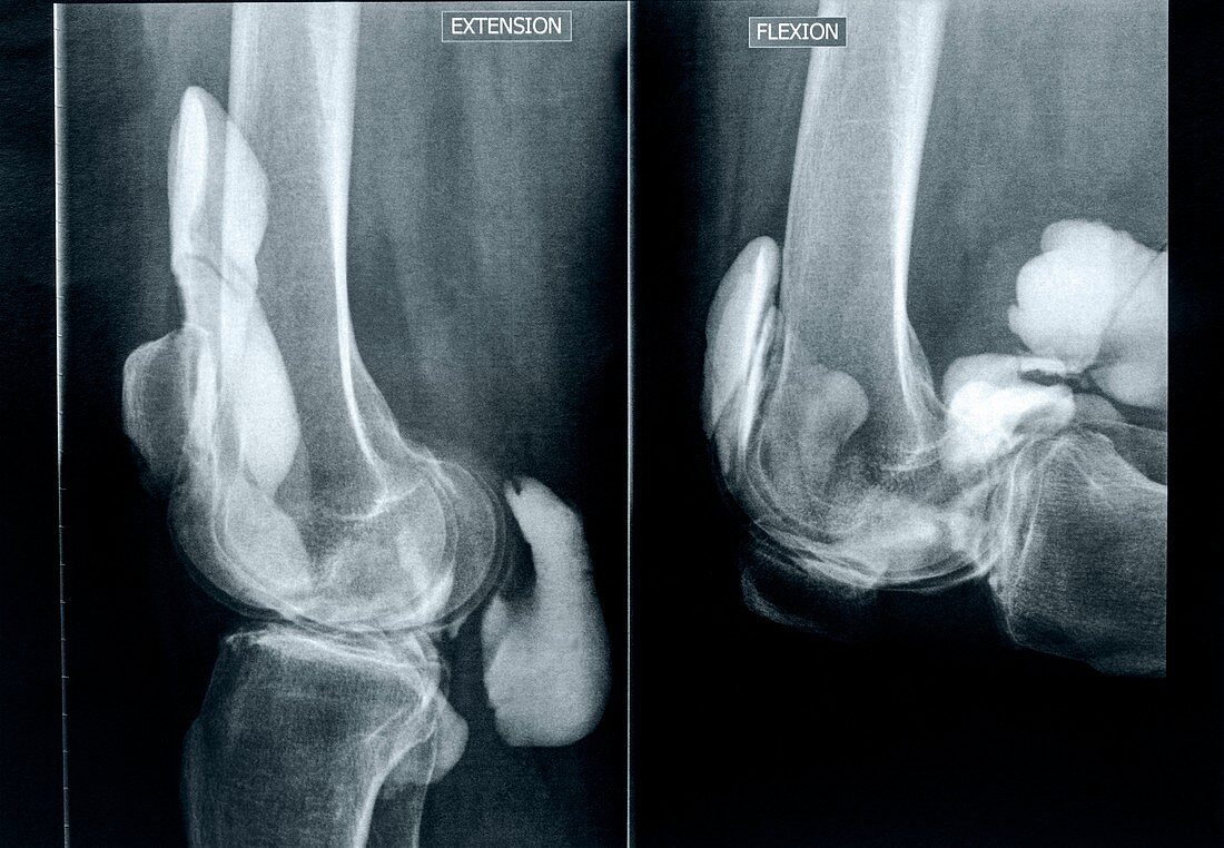 Knee extension and flexion,X-rays