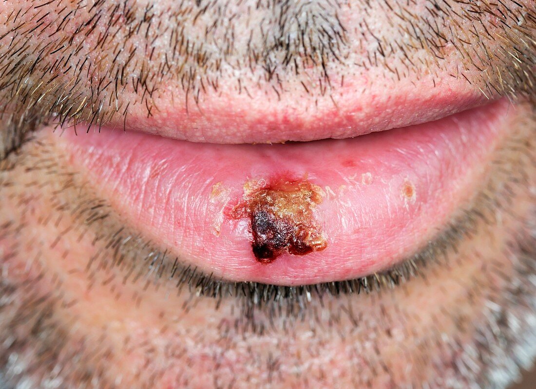 Infected cold sore