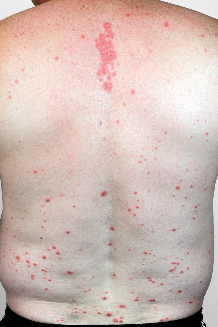 Psoriasis of the back