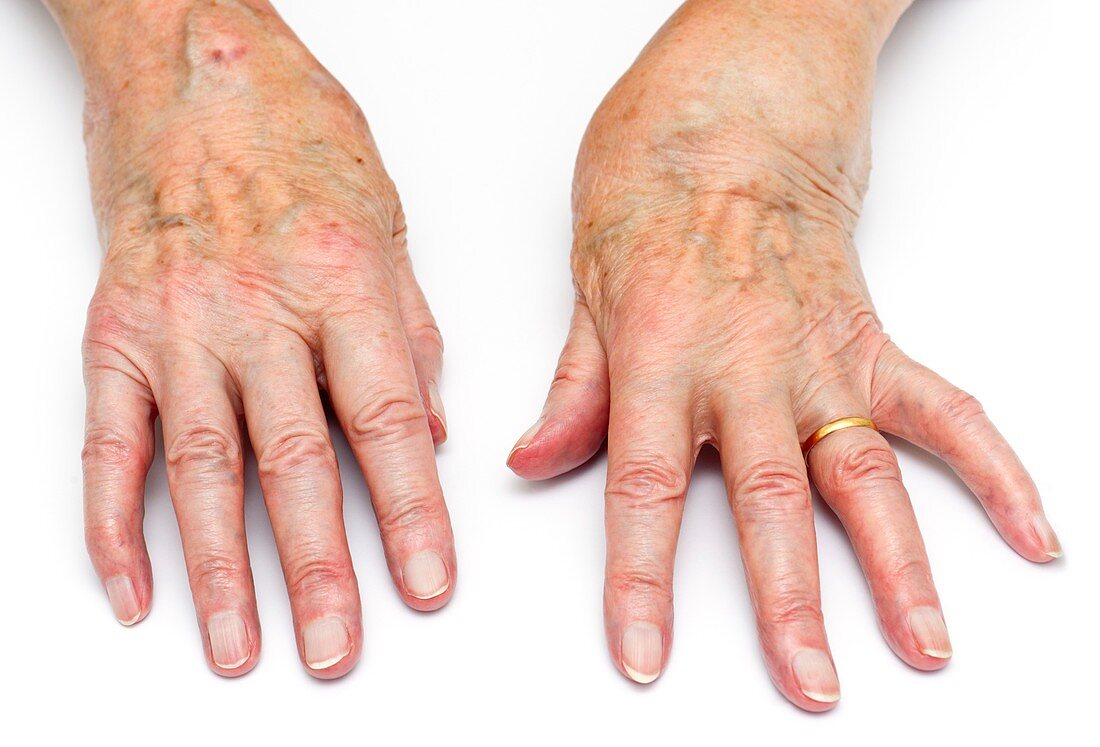 Rheumatoid arthritis of the wrists