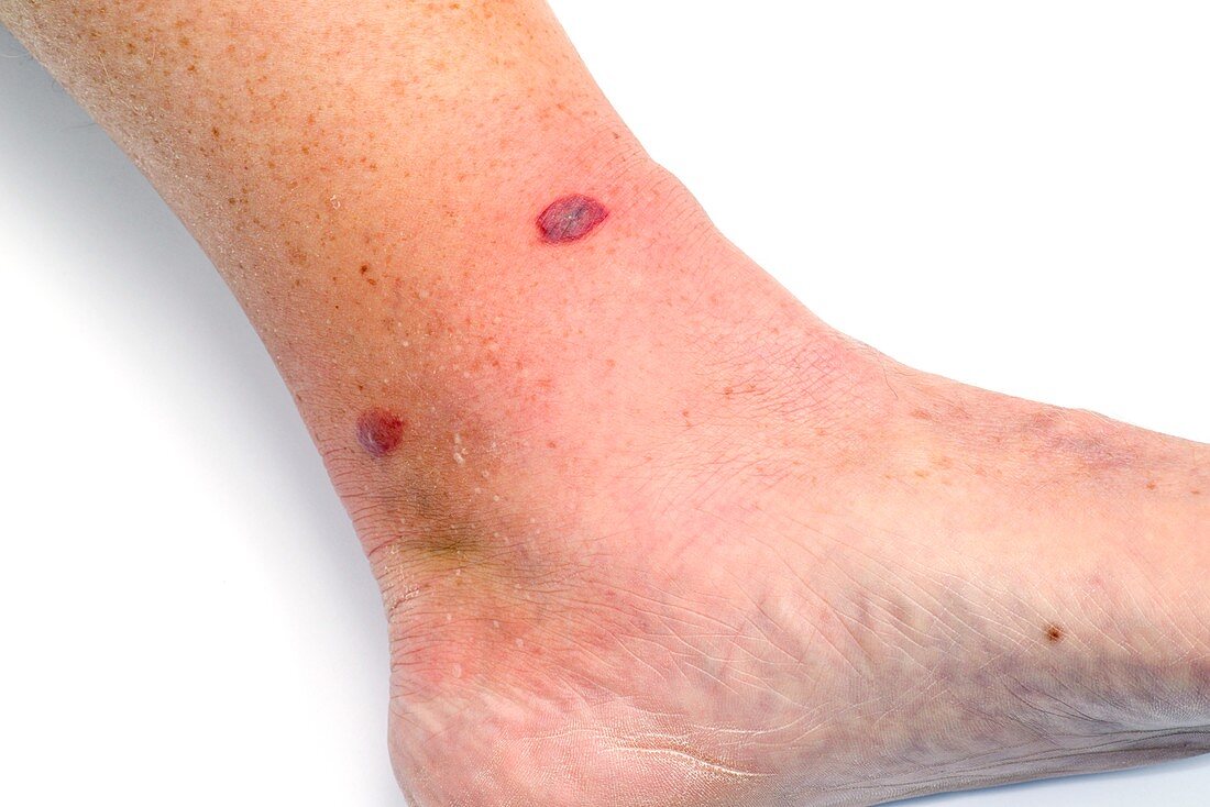 Cellulitis after insect bite