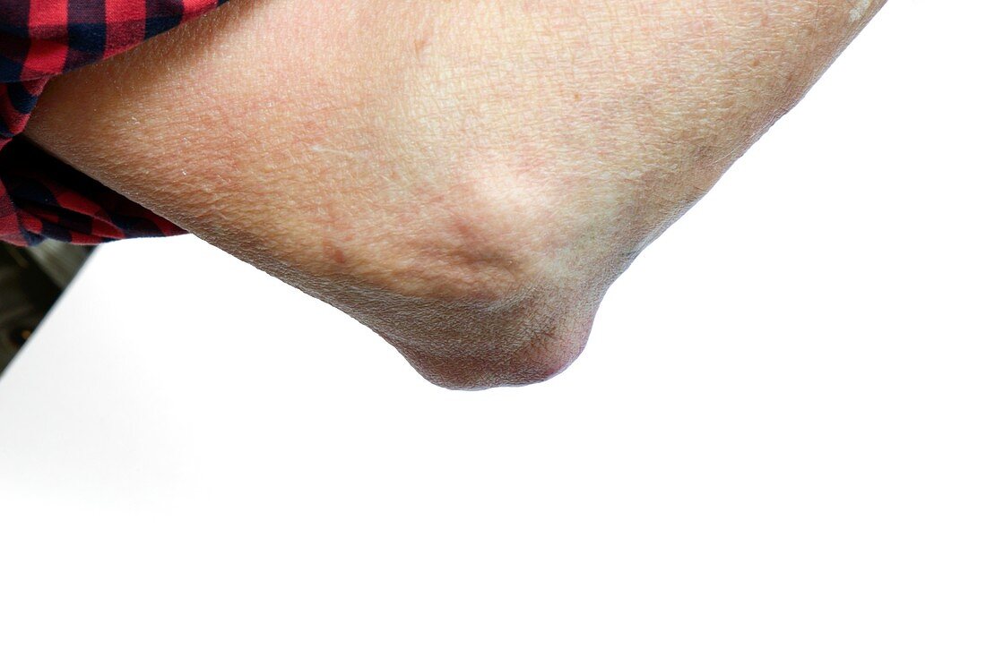 Rheumatoid nodule of the elbow
