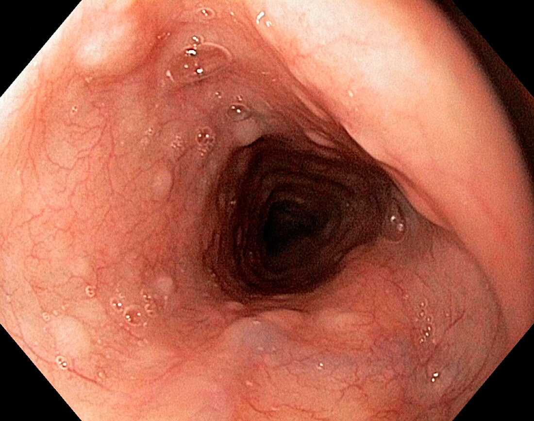 Glycogenic acanthosis,endoscope view