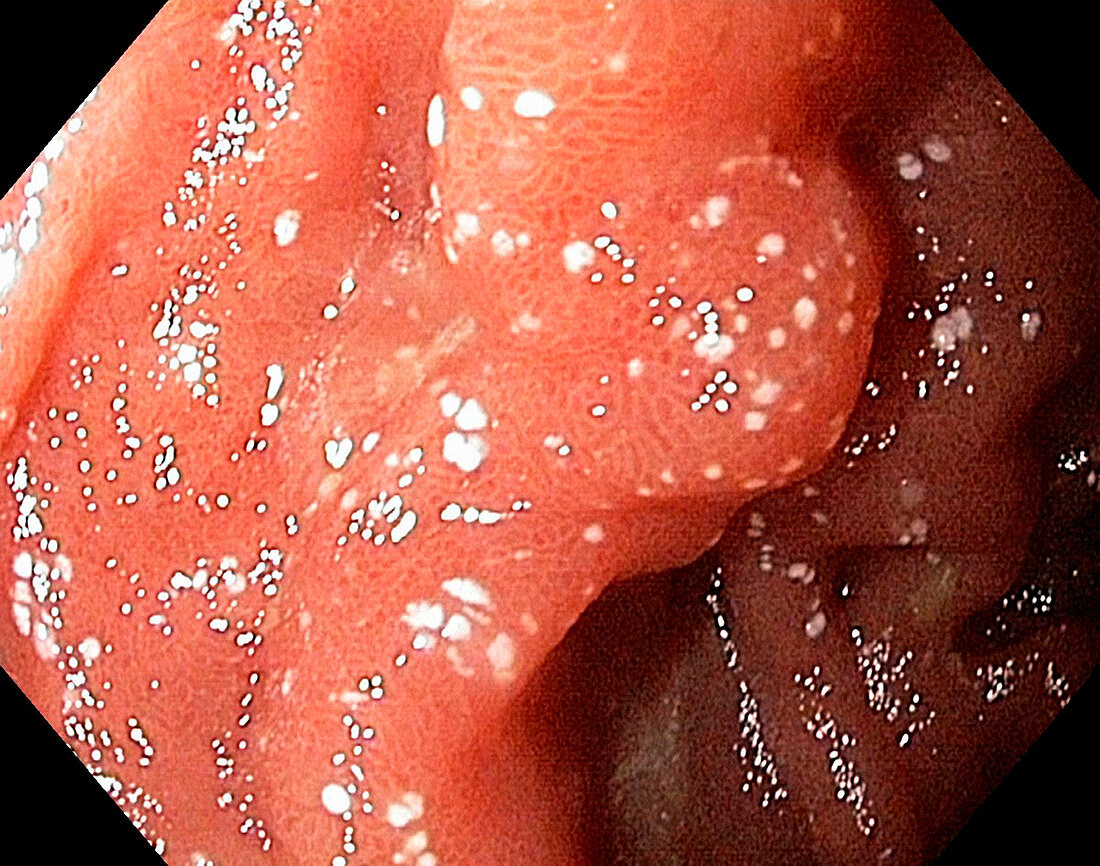 Lymphangiectasia in the duodenum