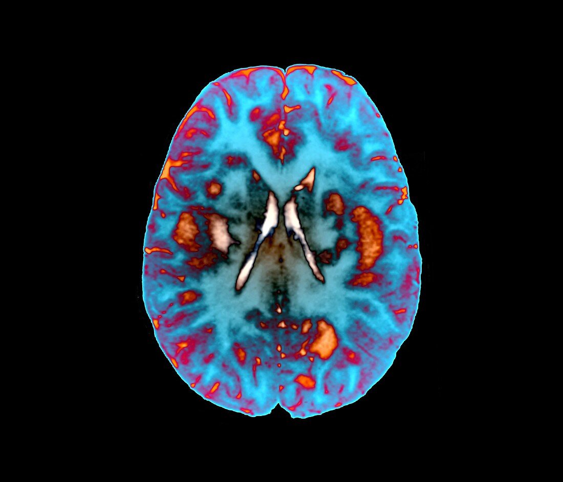 Acute disseminated encephalomyelitis,MRI