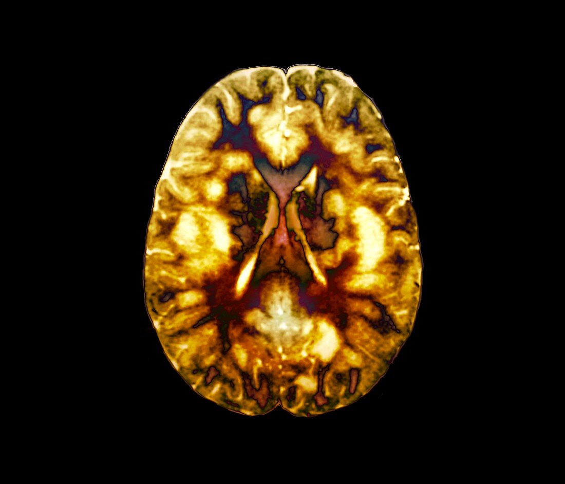 Acute disseminated encephalomyelitis,MRI