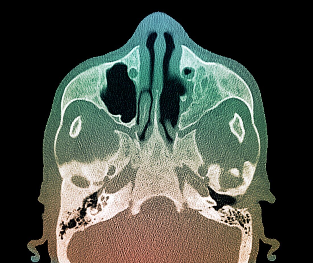 Bone damage in hyperparathyroidism,MRI