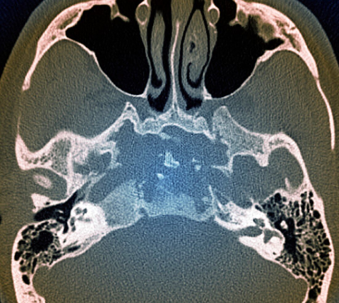 Skull in Erdheim-Chester disease,MRI