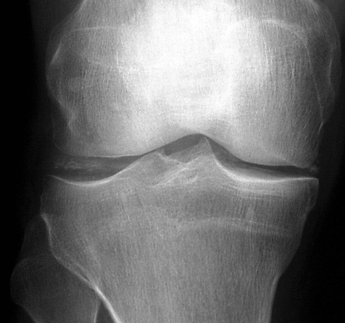 Calcification in the knee,X-ray