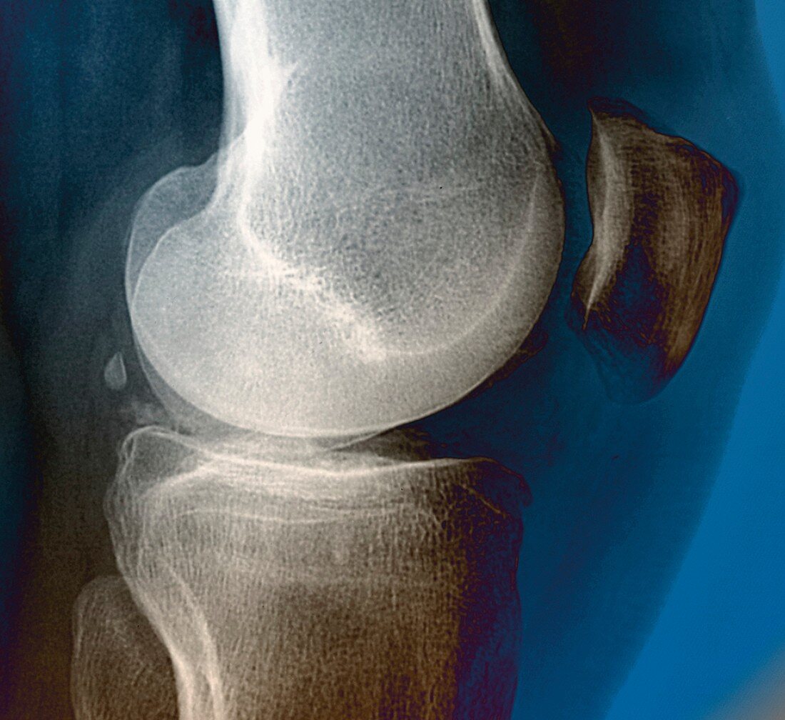 Calcification in the knee,X-ray