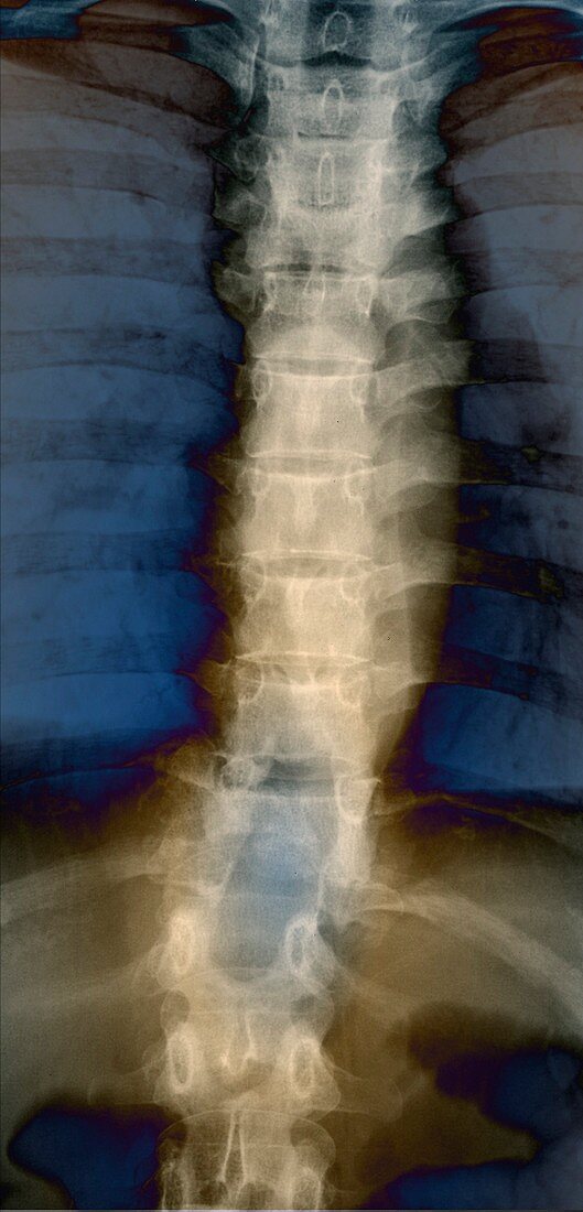 Spine in Pott's disease,X-ray
