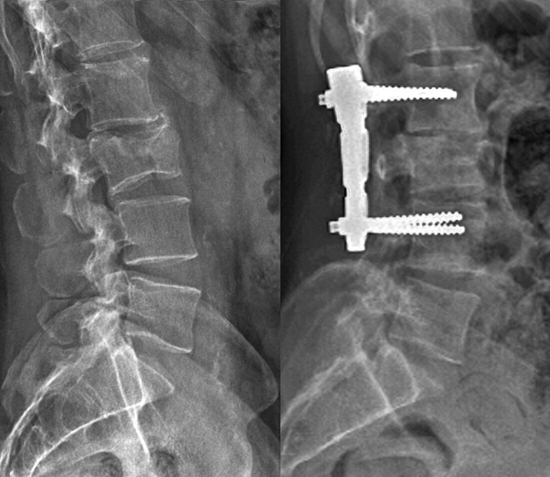 Pinned backbone,X-ray