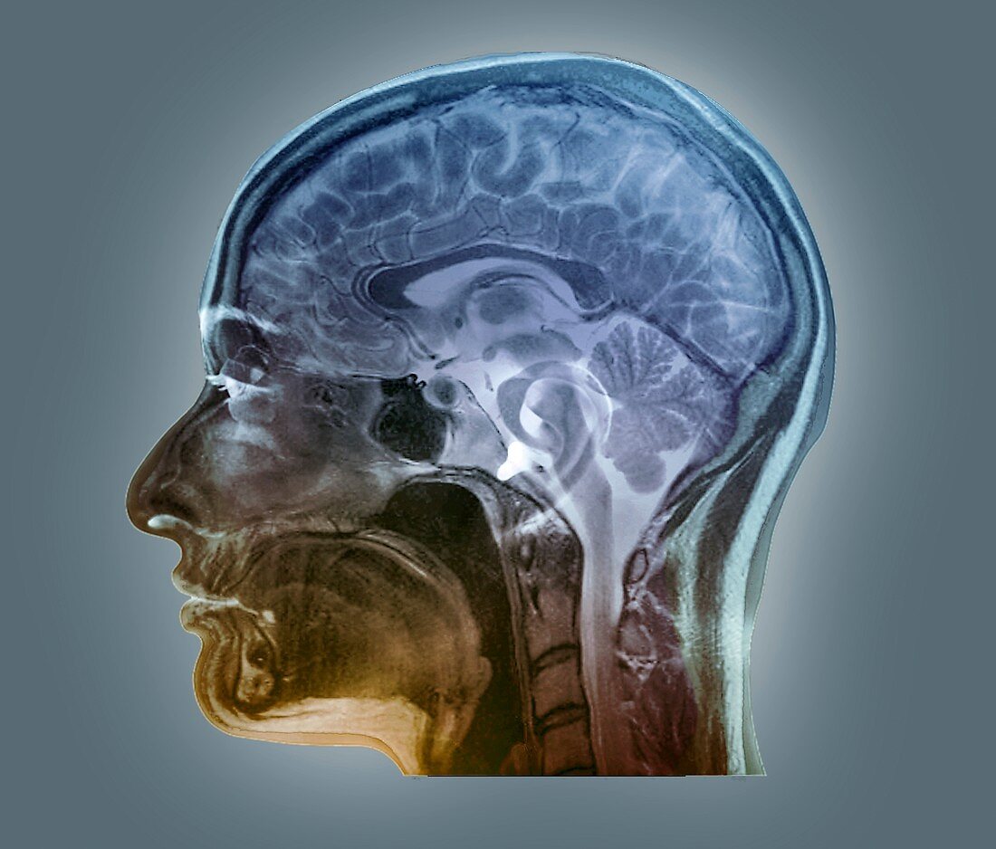 Brain anatomy,MRI