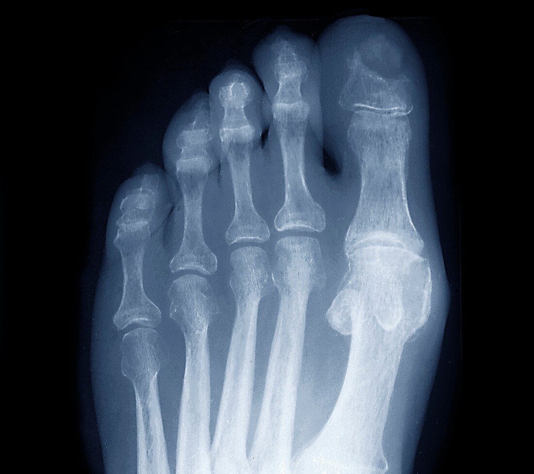 Osteonecrosis in diabetes,X-ray