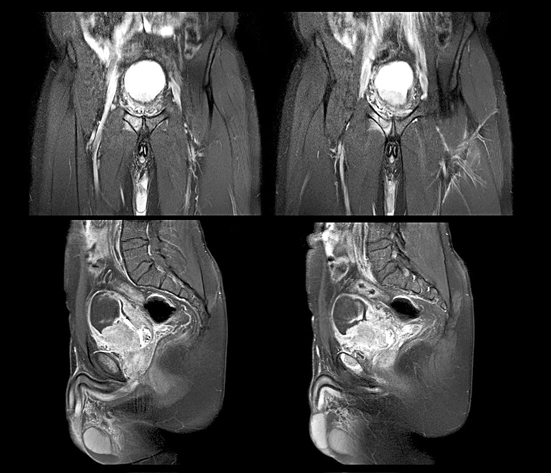 Metastatic bladder cancer,MRI