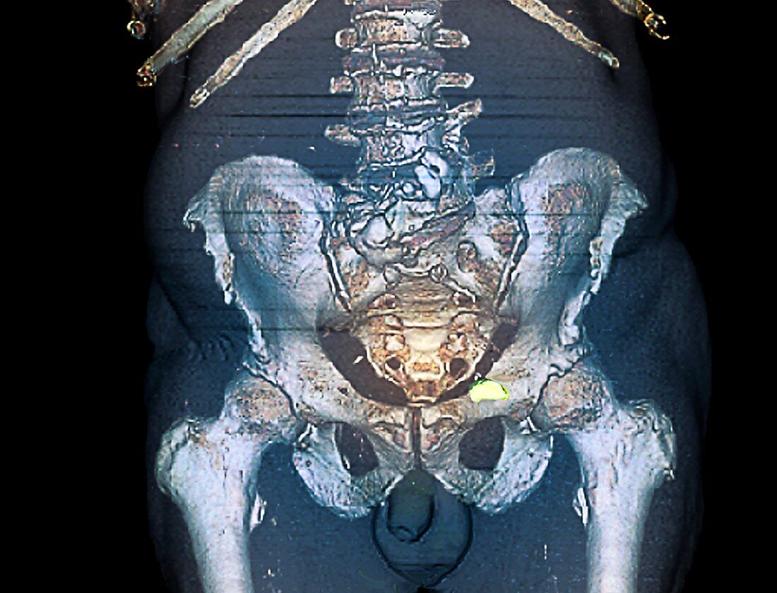 Metastatic prostate cancer,3D CT scan